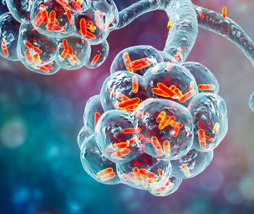 Alveoli polmonari e legionella