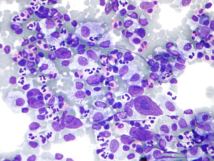 Il cancro: il linfoma di Hodgkin